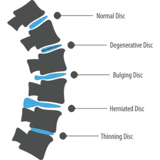 Cuadro de discos intervertebrales normales, degenerativos, abultados, herniados y adelgazados