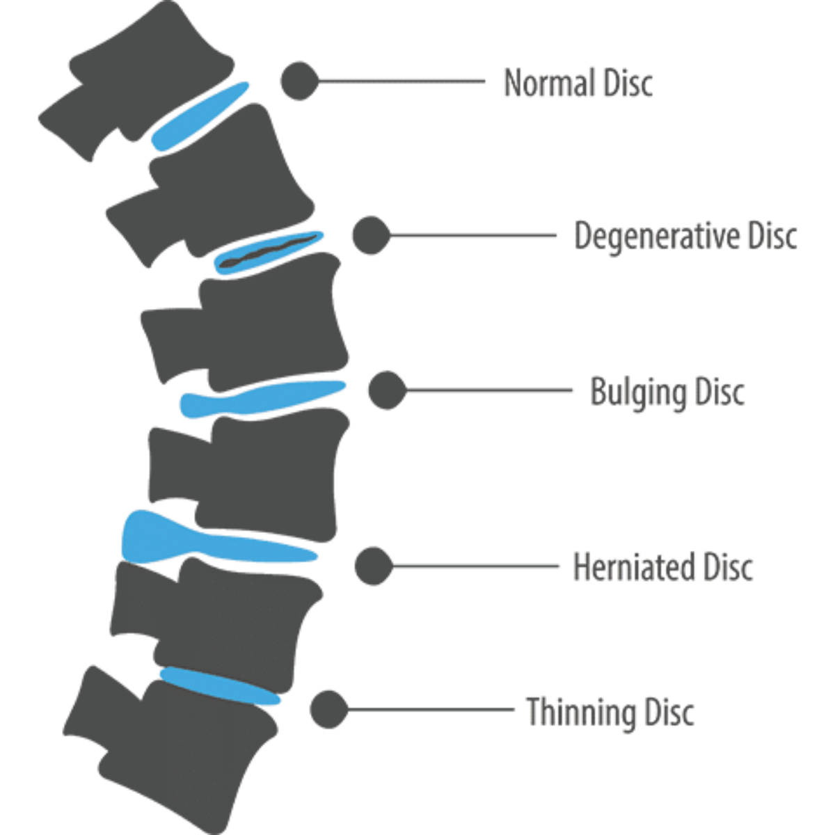 https://www.backfithealth.com/wp-content/uploads/degenerative-bulging-herniated-thinning-disc-chart-1200x1200.png