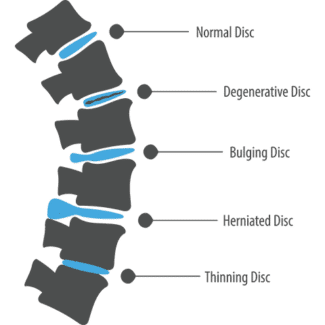 Chart of intervertebral discs that are normal, degenerative, bulging, herniated, and thinning