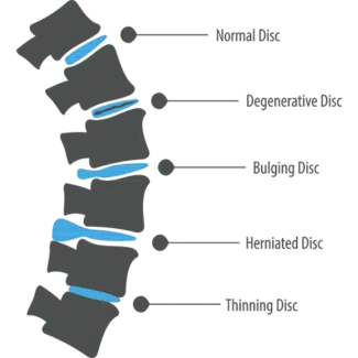 Chart of intervertebral discs that are normal, degenerative, bulging, herniated, and thinning