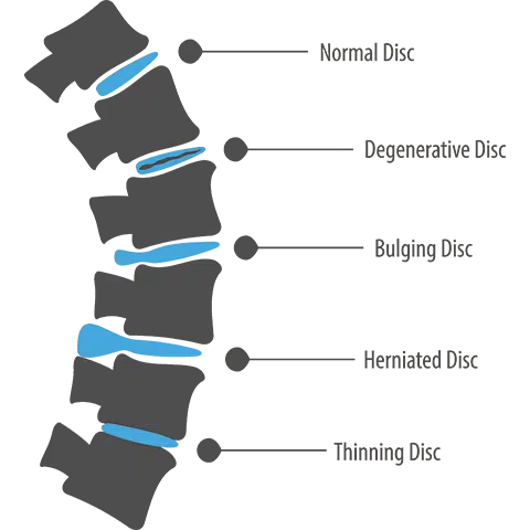 Chart of intervertebral discs that are normal, degenerative, bulging, herniated, and thinning