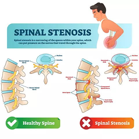 Diagram showing the change of spinal stenosis