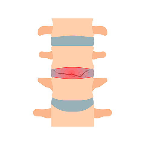 Illistration of a spine with one of the discs in between the bones is red and cracked