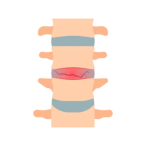 Ilustración de una columna vertebral con uno de los discos entre los huesos enrojecido y agrietado