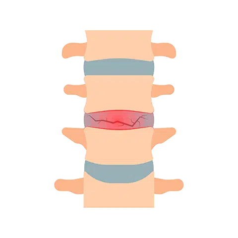 Illistration of a spine with one of the discs in between the bones is red and cracked