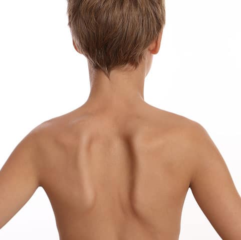Little boys back showing his shoulder blades that are uneven